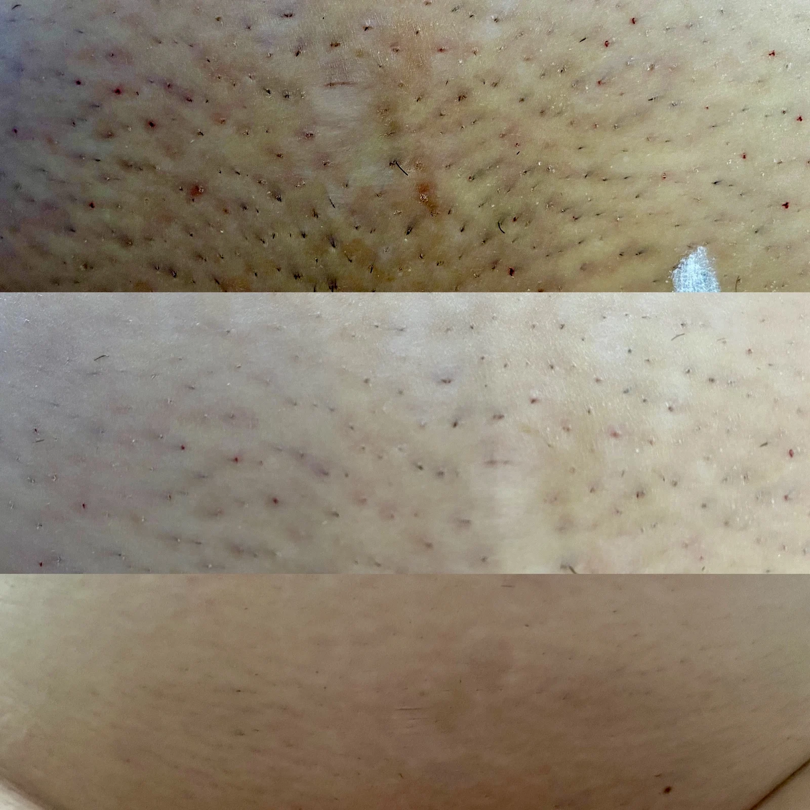 Efekty epilacji MDJ01 — przykład 11