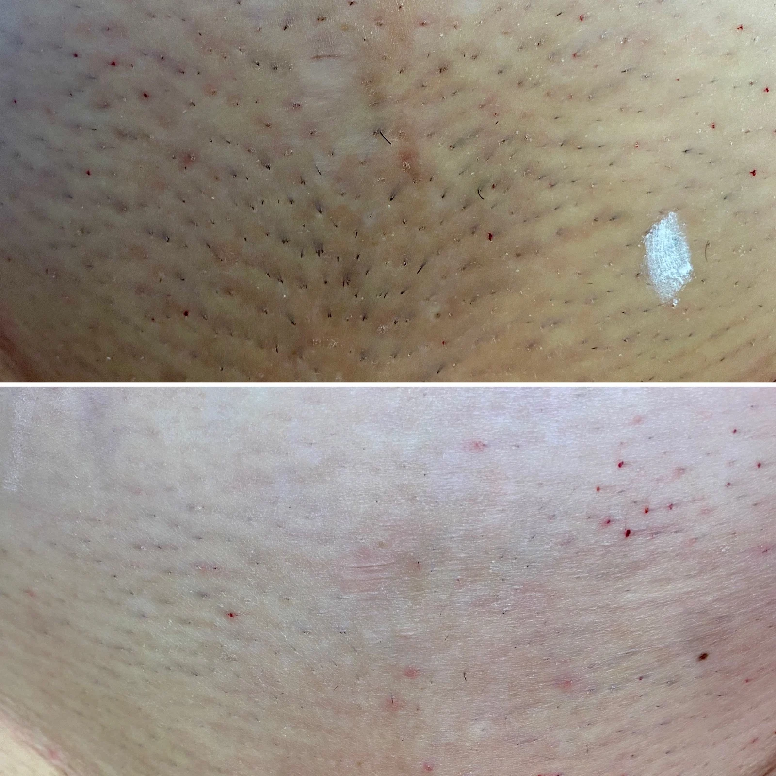 Efekty epilacji MDJ01 — przykład 7