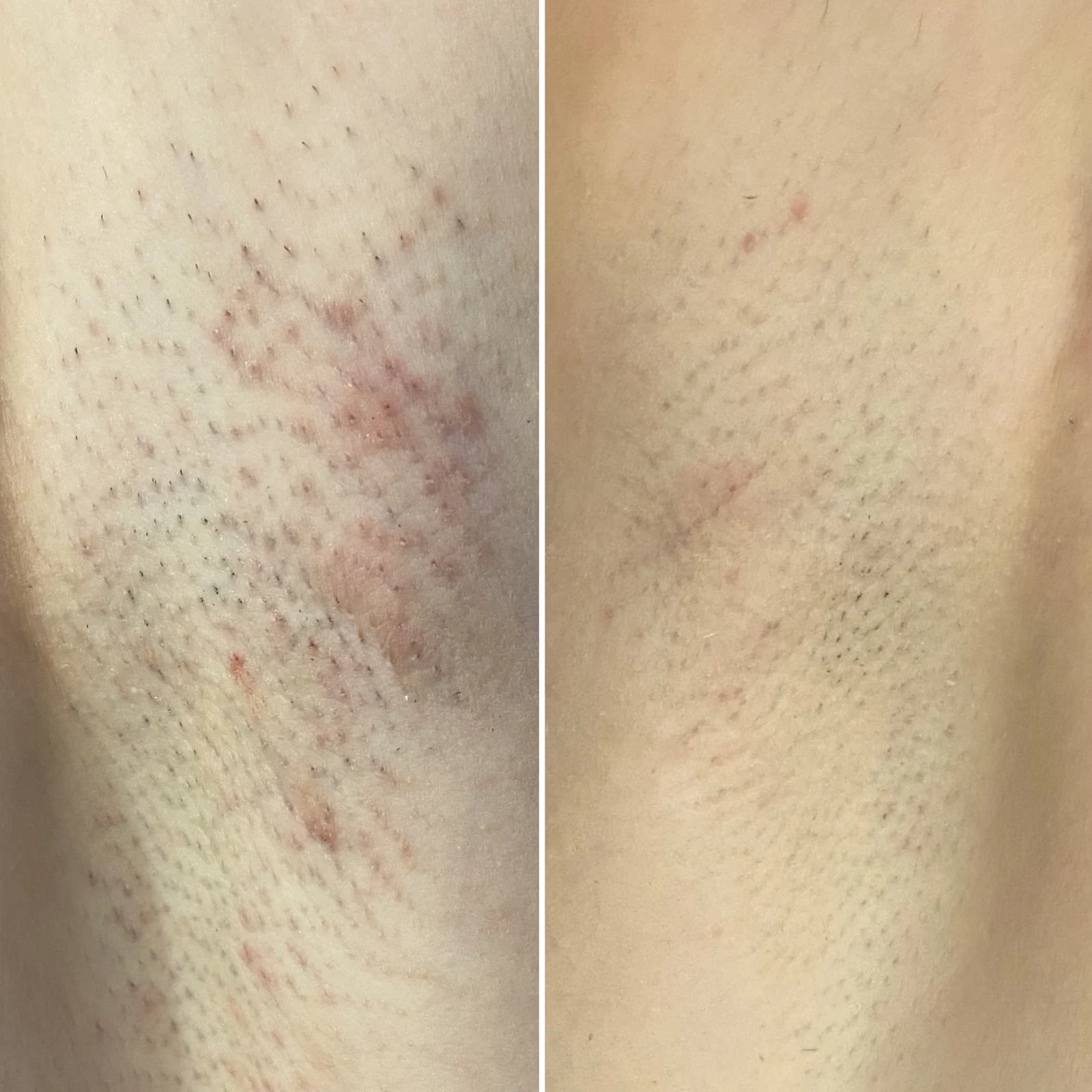 Efekty epilacji MDJ01 — przykład 9